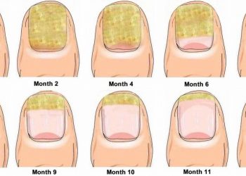 How to Treat Nail Fungal Infection