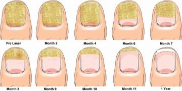 How to Treat Nail Fungal Infection