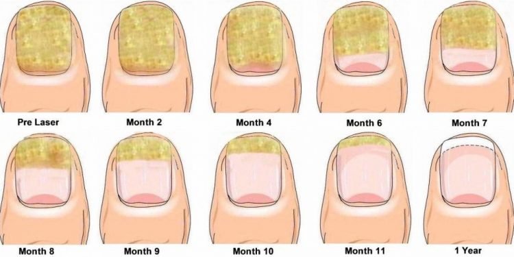 How to Treat Nail Fungal Infection