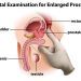 Can Enlarged Prostate Cause Erectile Dysfunction?