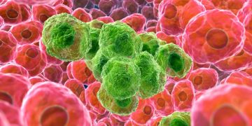 Cancer, Types, Causes, Effects, And Solution