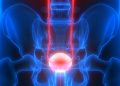 THE Bladder cancer
