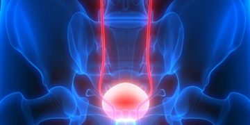 THE Bladder cancer
