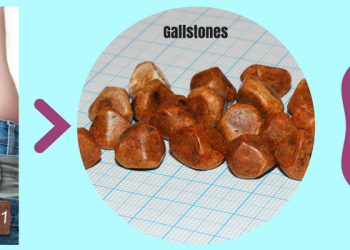 The link between weight loss and gallstones