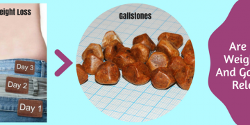 The link between weight loss and gallstones