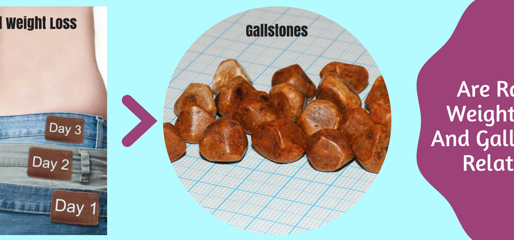 The link between weight loss and gallstones